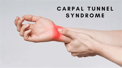 Physical Therapy For Carpal Tunnel Syndrome Reddy Care Physical