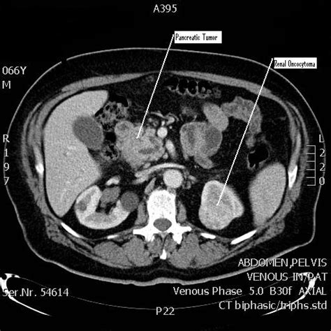 Stomach On Ct Scan