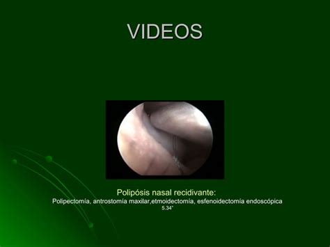 Cirugia Endoscopica En Poliposis Nasal Ppt