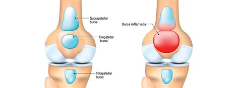 Todo Lo Que Necesitas Saber Sobre La Bursitis Fisiolution Las Tablas