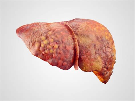 50 Facts About Liver Cirrhosis