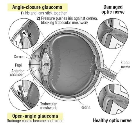 Open Angle Glaucoma Angle Closure Glaucoma Vision And Eye Health