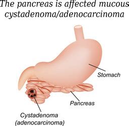 Pancreas Mucous Cystadenoma Adenocarcinoma Vector Image