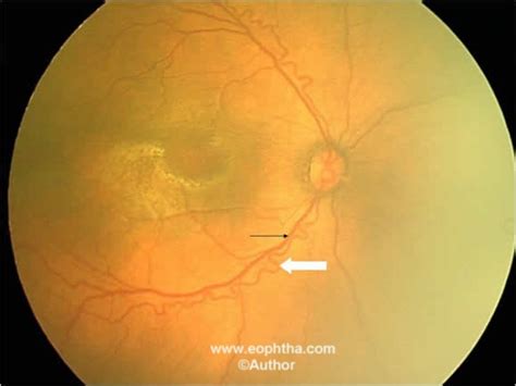 Retinopathy Of Prematurity Plus Disease