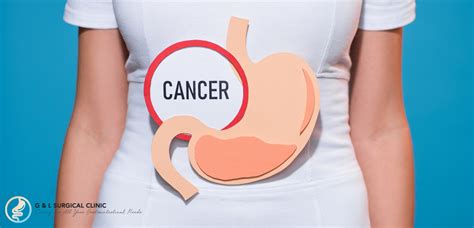 Stomach Cancer Tips To Recognising The Symptoms G And L Surgical