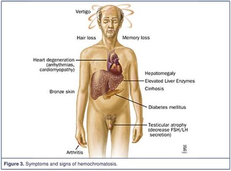 Hemochromatosis Treatment