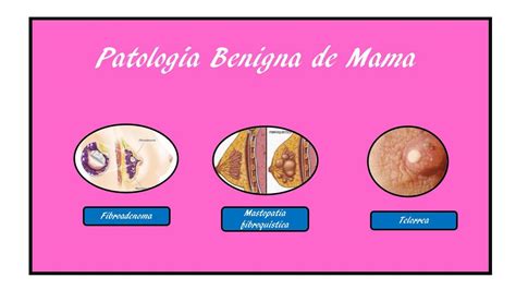 Que Es Patologia Benigna Mundo Multimedia