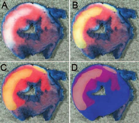 Planimetry Of Myocardial Infarct Size A Digital Photographs Of A