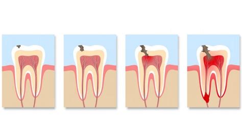 Cárie dentária saiba como a cárie invade o dente Clinica OralDents