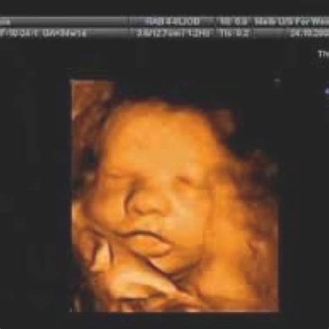 34 Weeks Pregnant Ultrasound Pic 34 Weeks Pregnant Ultrasound Baby