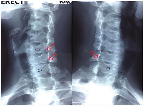 Oblique radiographs of the cervical spine demonstrate neuroforaminal... | Download Scientific ...