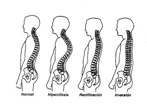 Ranking De Enfermedades De La Columna Vertebral Listas En 20minutos Es