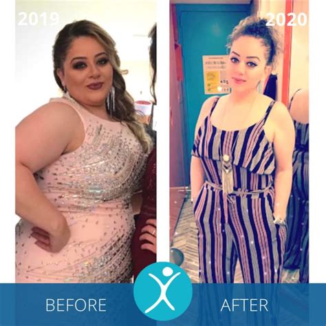 Gastric Sleeve Before and After Photos: Best Pictures of 2024