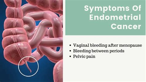 PPT - What Is Endometrial Cancer PowerPoint Presentation, free download ...