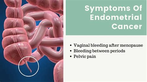 Ppt What Is Endometrial Cancer Powerpoint Presentation Free Download Id8495996