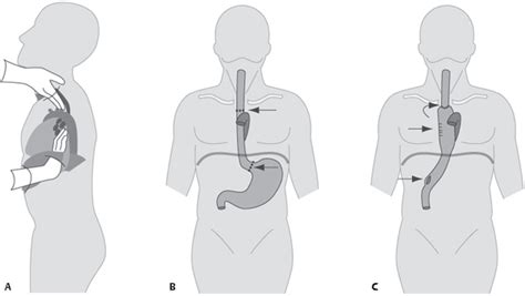 Mckeown Procedure Minimally Invasive Mckeown Esophagectomy With