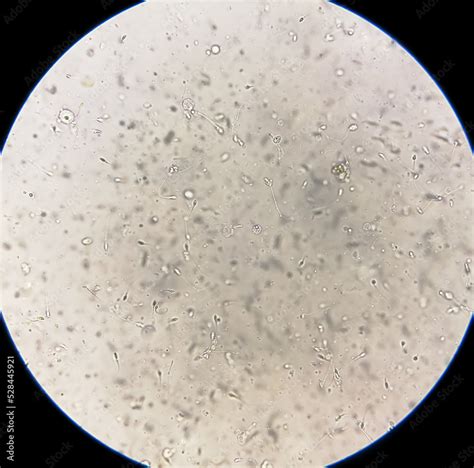 Semen Analysis Under Microscopy Showing Pyospermia Or Leukocytospermia