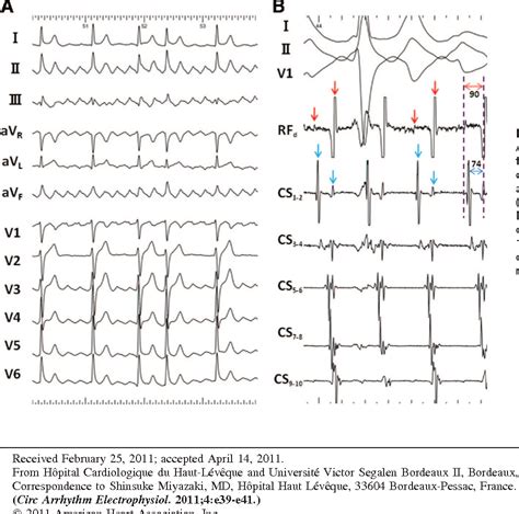 Figure From Recurrent Perimitral Tachycardia Using Epicardial