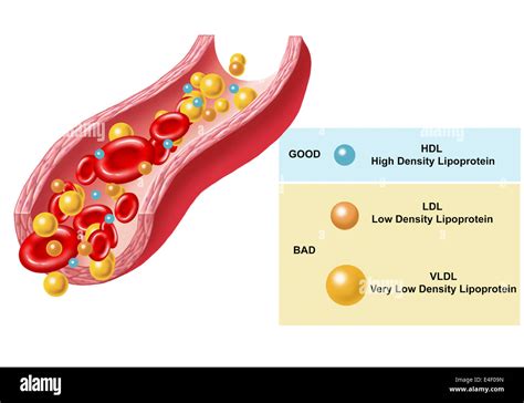 Elevated Blood Lipids