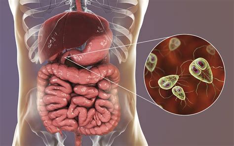 Giardiasis: síntomas y tratamiento - Mejor con Salud