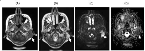 Pathologically Proven Recurrent Adenoid Cystic Carcinoma Of The Left