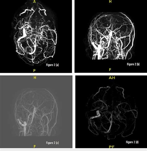 A D Magnetic Resonance Venography Mrv Of The Brain There Is Absent