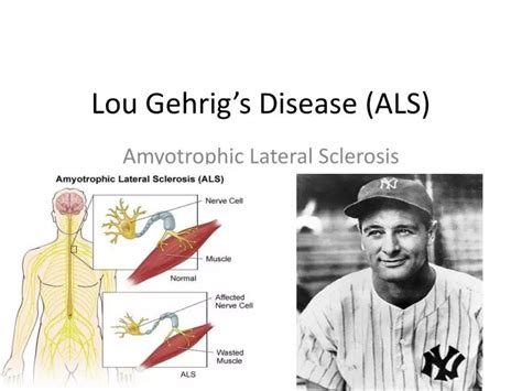 PPT - Lou Gehrig’s Disease (ALS) PowerPoint Presentation, free download ...