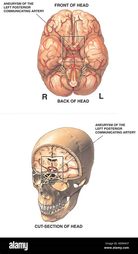 Missing Posterior Communicating Artery