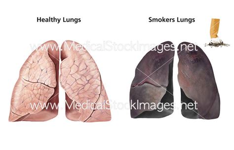 Healthy Lungs And Smokers Lungs Medical Stock Images Company