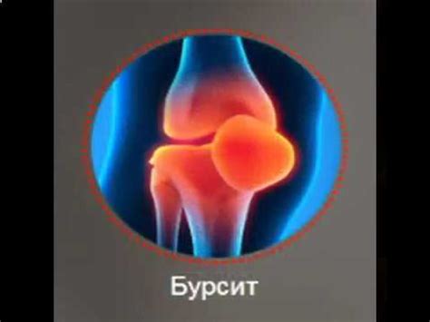 боль в коленном суставе и голени - YouTube