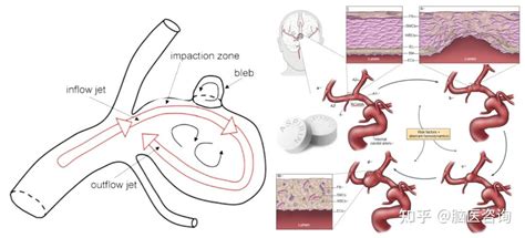阿司匹林与颅内动脉瘤的情缘 知乎