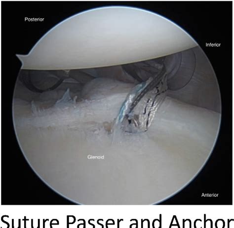 Figure 1 From Posterior Labral Repair Using Knotless “all Suture