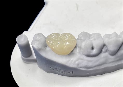 Accurate Fit Dental Ceramic Inlays Onlays Porcelain Inlays And Onlays