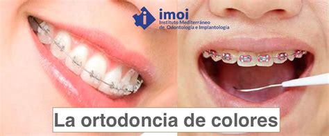 Total 71 Imagen Modelo De Ligas De Brackets Abzlocal Mx