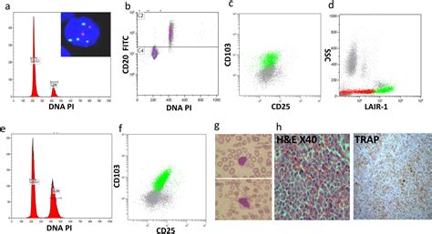 Hairy Cell Leukemia‐variant Without Typical Morphology And With Near‐tetraploid Dna Content