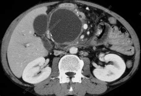 Pancreatic pseudocyst, CT scan - Stock Image C018/7156 - Science Photo Library