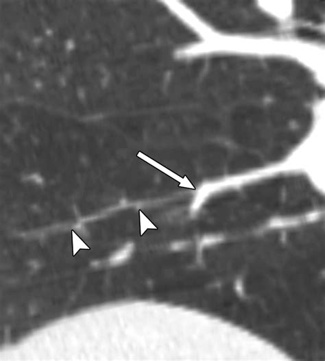 How I Do It Ct Pulmonary Angiography Ajr