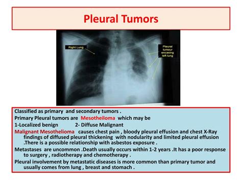 PPT - Pleural Tumors PowerPoint Presentation, free download - ID:2178232