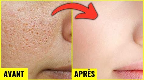 Pores Dilat S Solutions Radicales Pour Les Resserrer Au Naturel