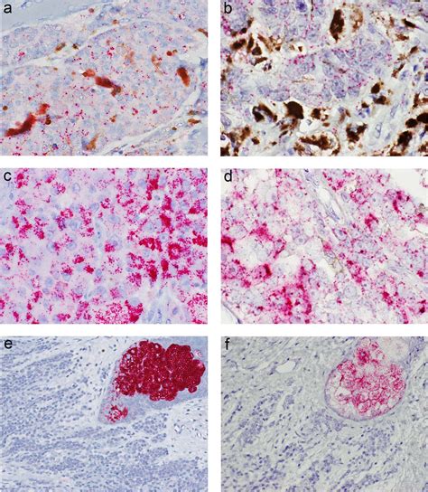 Adipophilin Expression In Cutaneous Malignant Melanoma Is Associated