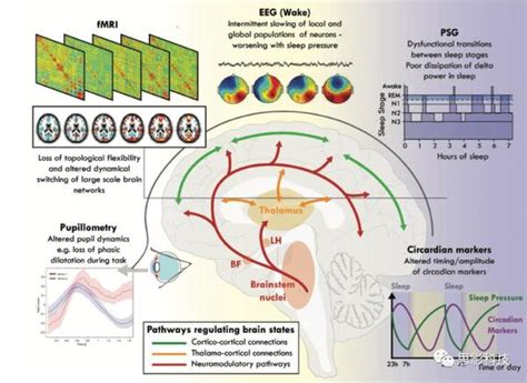 Brain：路易体痴呆的波动性认知障碍：病理生理学框架 知乎