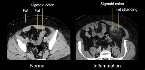 Abdominal Ct Common Terms Litfl Radiology Library