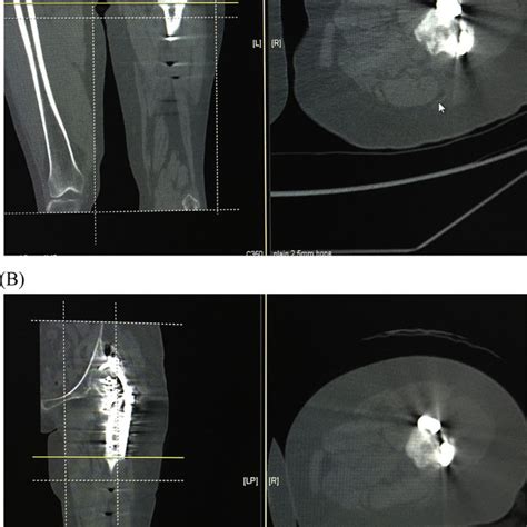 A Computed Tomography At 6 Months Postoperatively Showing Persistent Download Scientific