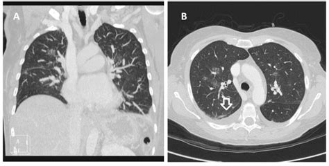 Chest Ct Scan Showing Evidence Of Pulmonary Edema A B Download