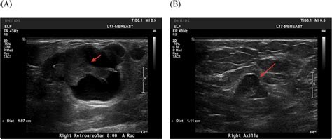 Ductal Dilatation Ultrasound