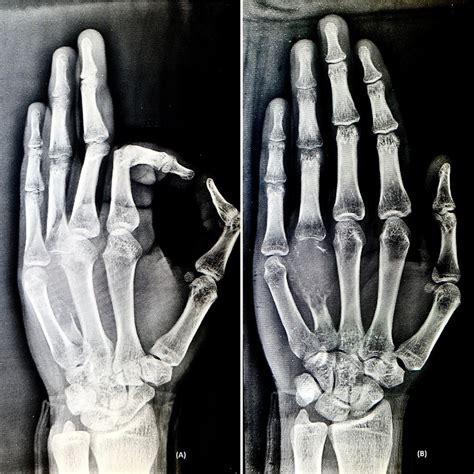 Radiograph Of The Left Hand In A Oblique View And B Anteroposterior