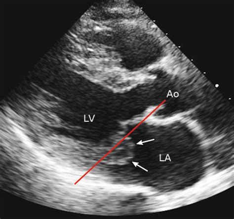 Prolapso Mitral Michel Kalansky