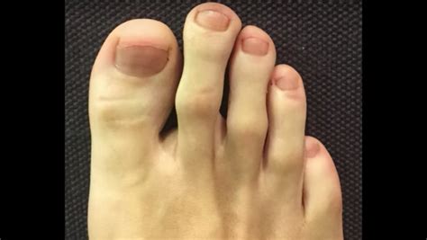 A Comprehensive Discussion On Mortons Toe Treatment