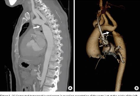 Pdf Management Of Coarctation Of The Aorta In Adult Patients State Of The Art Semantic Scholar