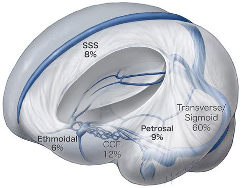 Arteriovenous Fistula | Expert Surgeon | Aaron Cohen-Gadol MD